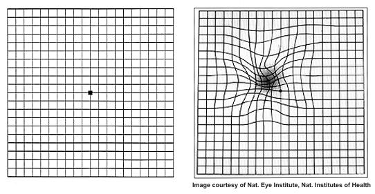 Amsler Grid for AMD