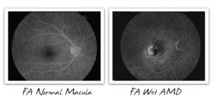 Fluorescein Angiogram Normal vs. Wet AMD