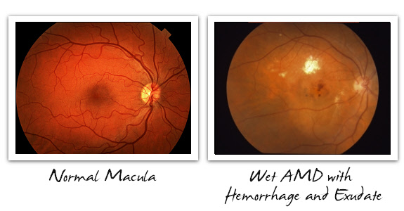 Normal Macula vs. Wet AMD 