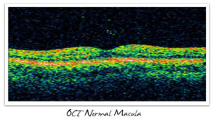 OCT Normal Macula