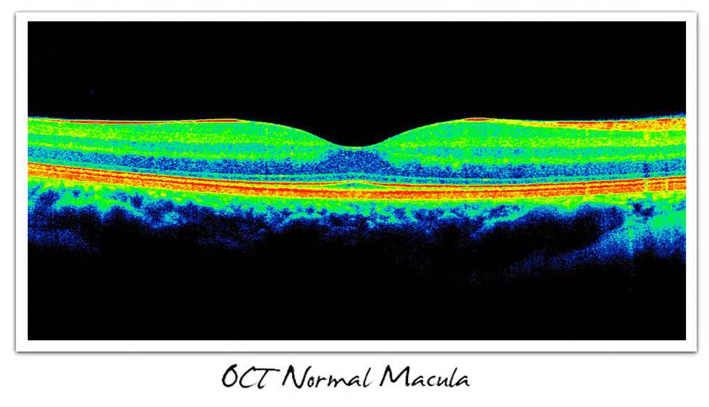 OCT Normal Macula