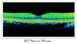 OCT Normal Macula