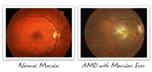 Normal Macula vs. AMD with Macular Scar