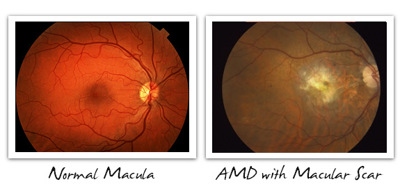 Normal Macula vs. AMD with Macular Scar