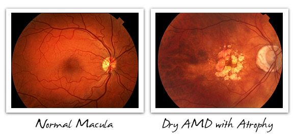 Normal Macula vs. Dry AMD with Atrophy
