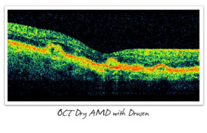 OCT Dry AMD with Drusen