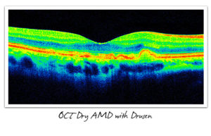 OCT Dry AMD