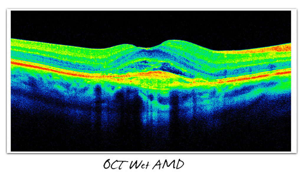 OCT Wet AMD