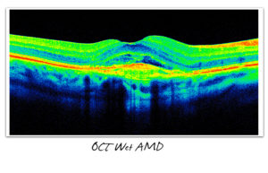 OCT Wet AMD