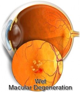 Wet AMD Image