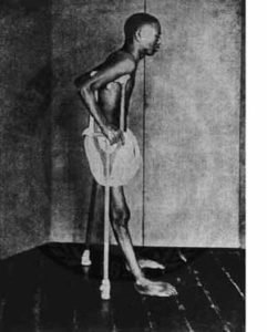 Adult male suffering from beriberi, early 20th century, Southeast Asia