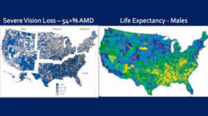 AMD Prevalence Increased in Men with Shortest Life Expectancy, USA CDC Data