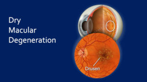 Dry Age Related Macular Degeneration
