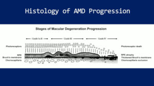 Histology of Age Related Macular Degeneration