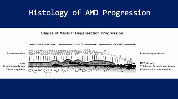 Histology of Age Related Macular Degeneration 