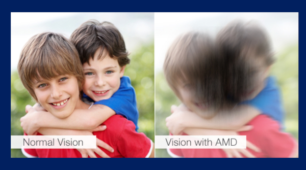 AMD and Simulated Vision Loss