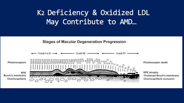 Vitamin K2 Deficiency and Macular Degeneration