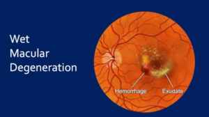 Wet Macular Degeneration