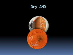 Dry Macular Degeneration (AMD)