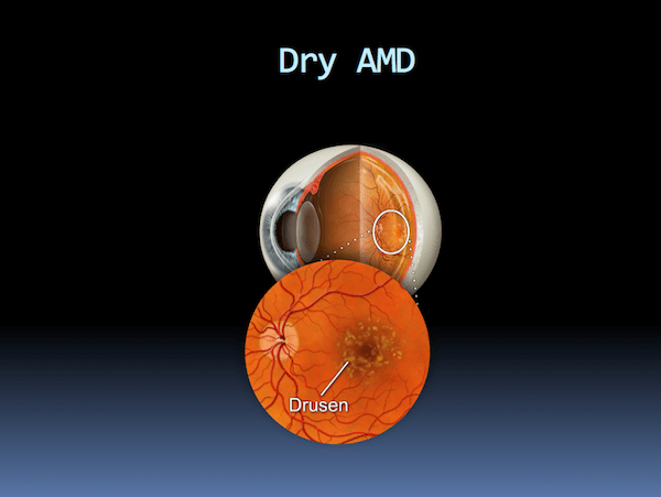 Dry Macular Degeneration (AMD) 