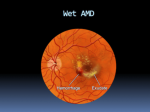 Wet AMD Macular Degeneration